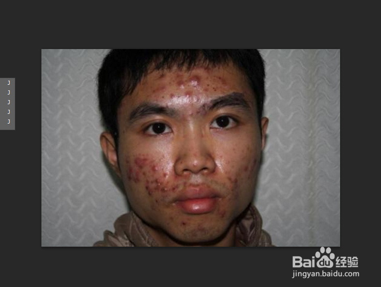 祛痘印最快的方法