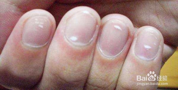 小孩蛔虫病有哪些症状，如何预防蛔虫病