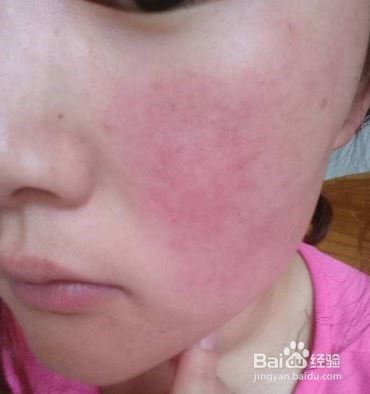 皮肤为什么会出现红血丝呢？