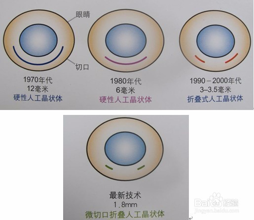 关于白内障你应该了解的5件事