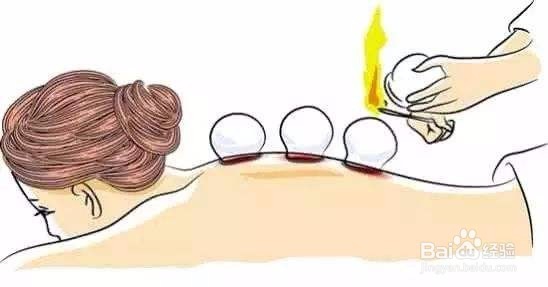 拔罐有什么讲究吗？