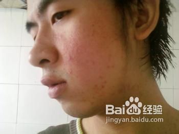 熏衣草精油为何能袪痘