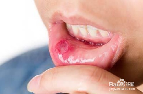 口腔溃疡膜的使用方法