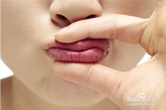 嘴唇干裂脱皮怎么办?