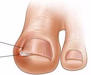 脚趾甲长进肉里了怎么办？？