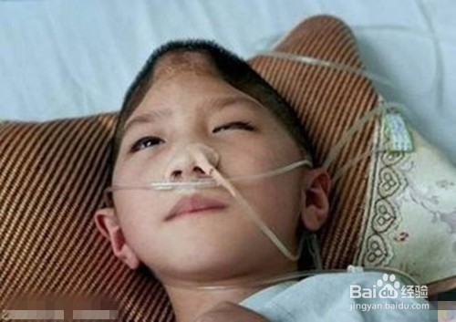 脑血管意外有哪些特征?