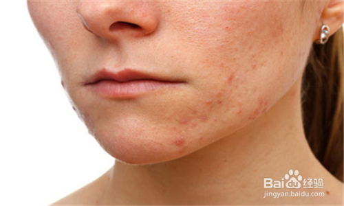 脸上长痘痘都有哪些原因？
