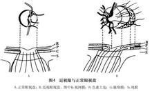 散光的症状是什么？