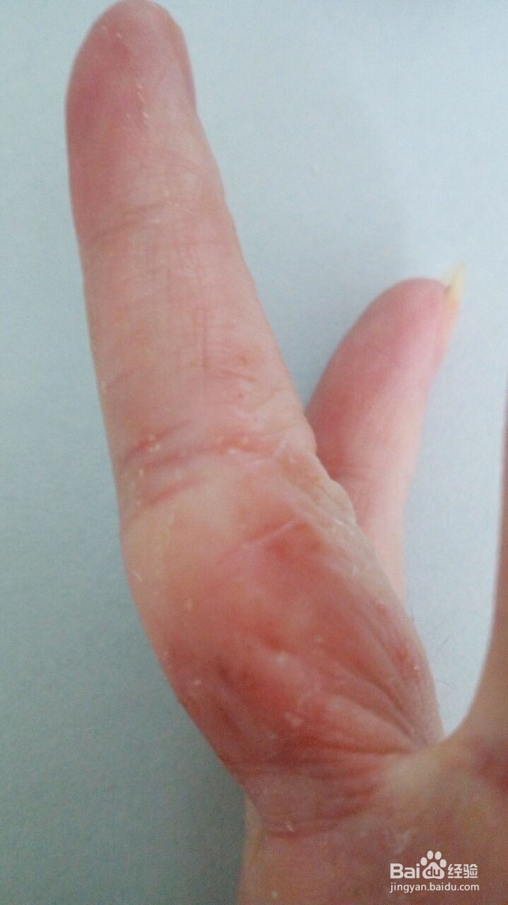 手指小水泡的治疗过程（真实经验）