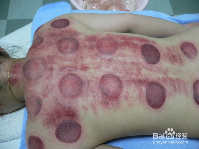 拔火罐,你了解多少?