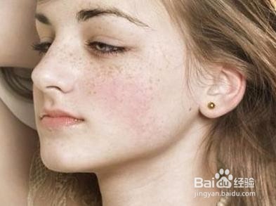 雀斑怎么才能祛斑