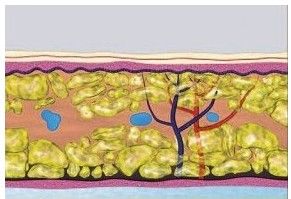 水动力吸脂对比图