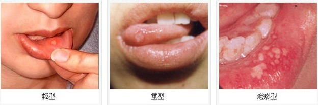 预防口腔溃的方法