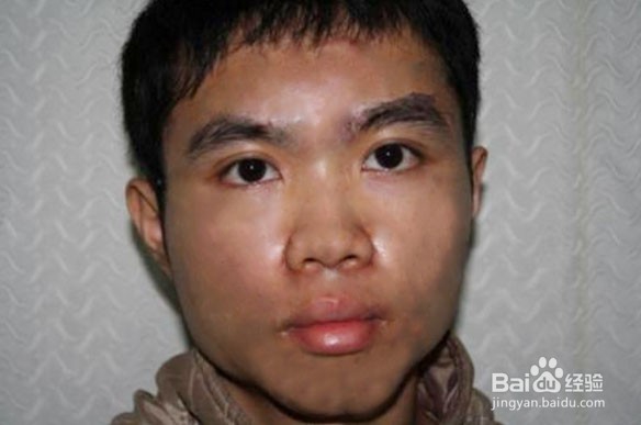 祛痘印最快的方法