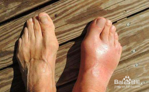 风湿关节炎和痛风有什么区别