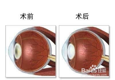 白内障患者术后应该怎么样护理