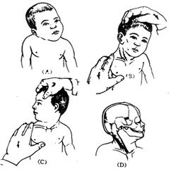 痉挛性斜颈是不是可以自愈？