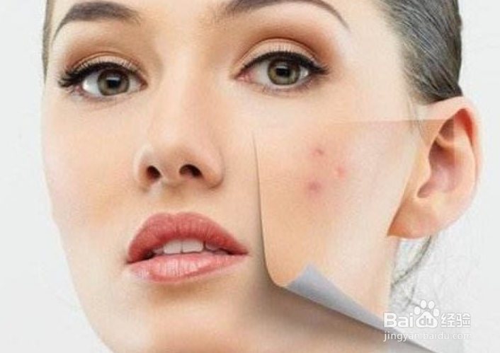 有了青春痘别去挤,这才是正确的祛痘方法