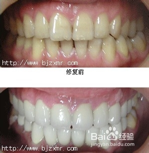 妈妈该了解的牙齿矫正的危害