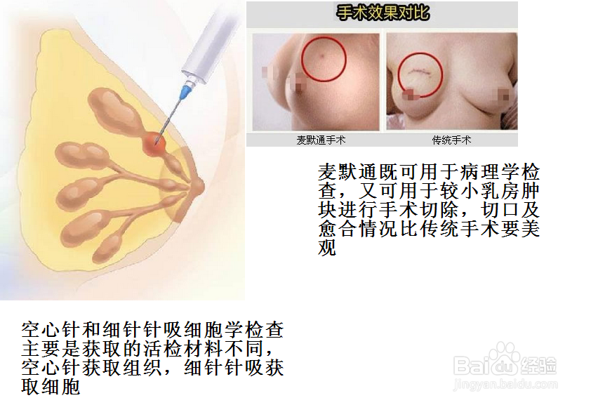 乳房肿块要做哪些检查