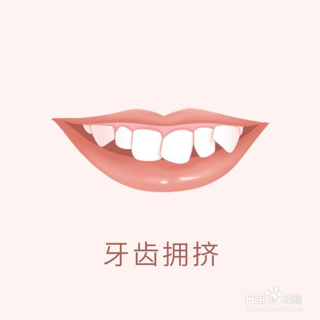 牙齿矫正类型