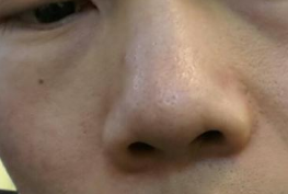 闹心的毛孔粗大怎么办？