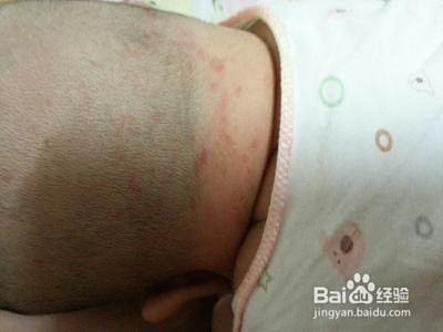 脖子上长湿疹的怎么办 百度经验