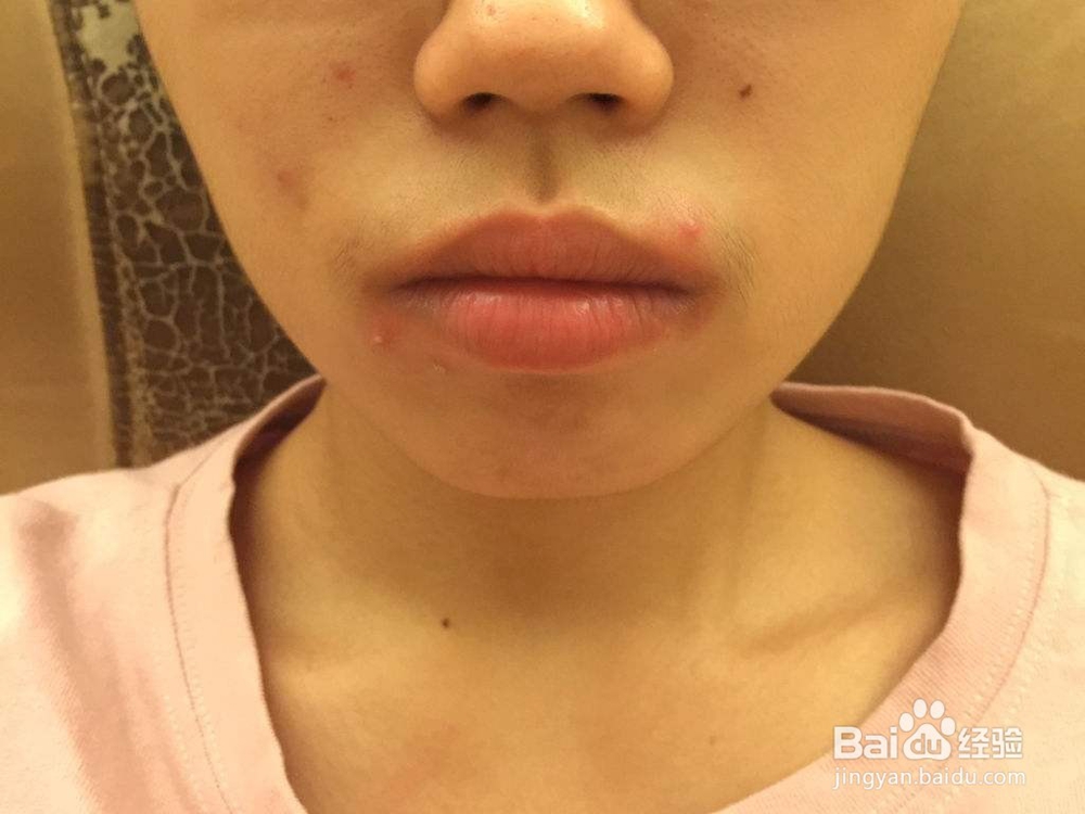 长痘痘的原因及调理方法