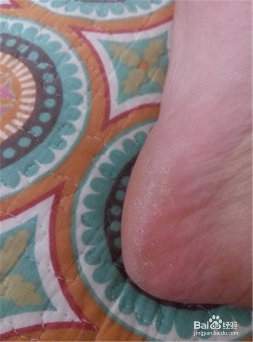 如何去除脚后跟死皮？保养脚也很重要哦！