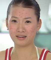 PS如何给有痘痘的皮肤进行美白