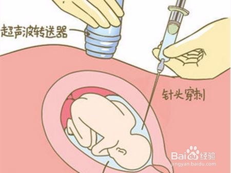 请问抽羊水需要动手术吗