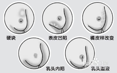 乳腺癌有什么症状