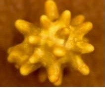 如何认识“肾结石”