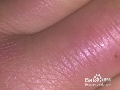 冻疮的药物治疗方法