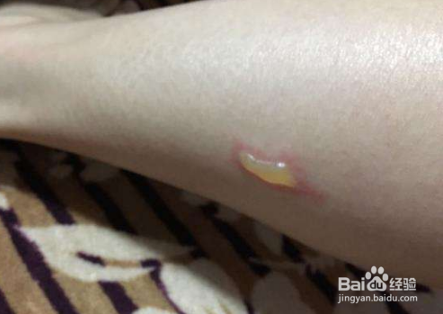 烧伤或烫伤怎样处理,应该注意哪些问题