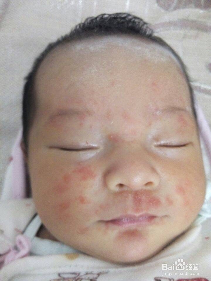 宝宝患上湿疹应该如何护理