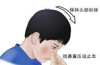 鼻子流血怎么止血，快速有效。
