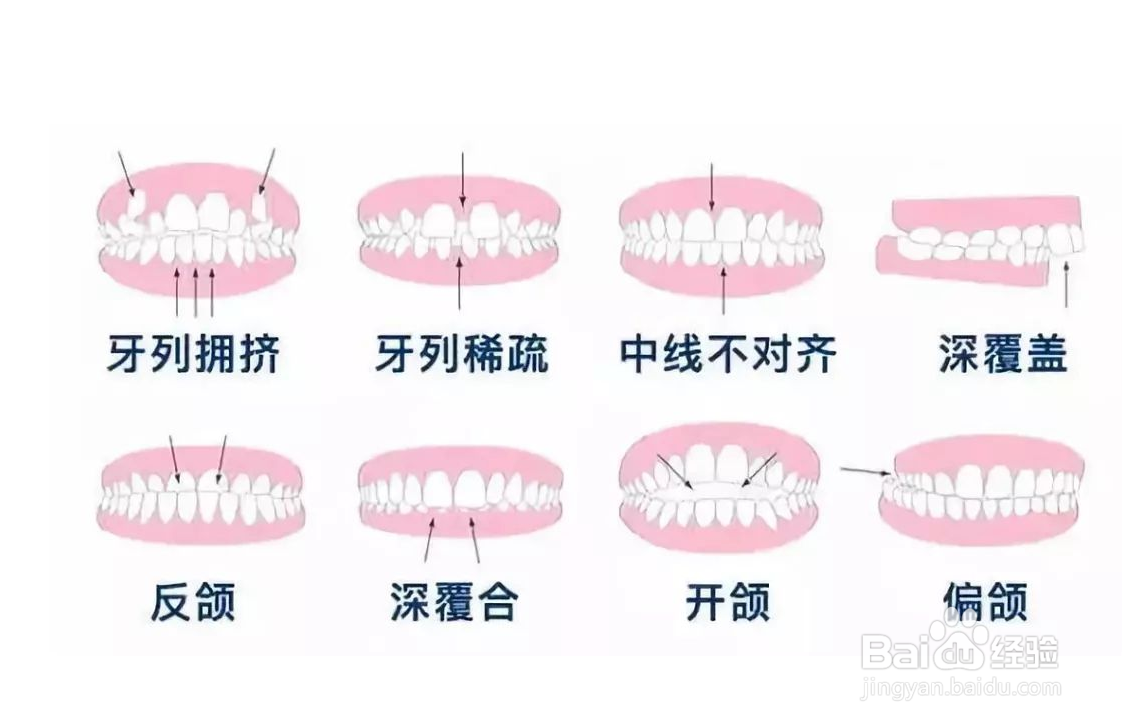 整完牙为什么要带保持器？
