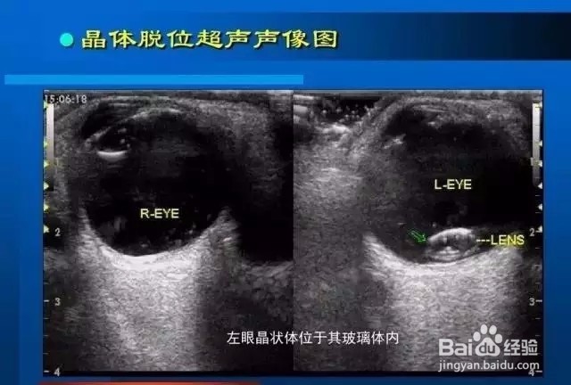 几种常见眼病B超图谱及诊断