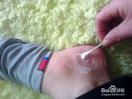 脚气是怎么引起的 如何防治脚气 百度经验