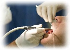 关于洗牙的那些事