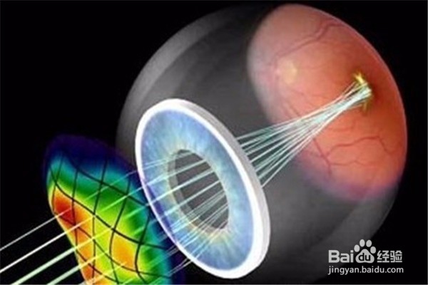 做完近视手术之后怎么恢复的技巧