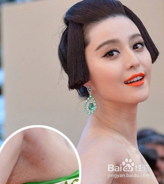 黑斑要怎么去除