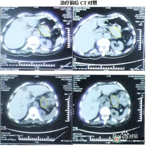 胰腺癌肝转移治疗方法有哪些