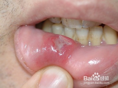 我来告诉你为什么你的口腔总是溃疡？