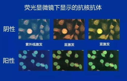 抗SSA/SSB抗体是什么