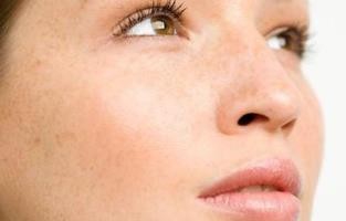 雀斑怎么才能祛斑