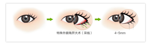 韩式整形：[6]外眼角开大方法好吗
