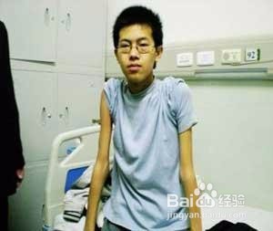 运动神经元病能治吗？