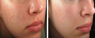 欣疤克祛疤真的有用吗?